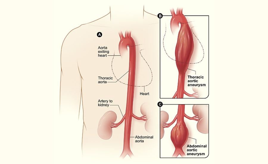 Aortic Aneurysms